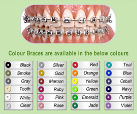 Coloured bands available for braces