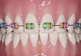Coloured bands on braces