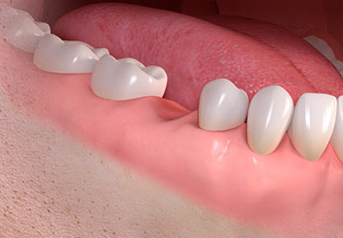 Conventional treatment - A tooth is missing