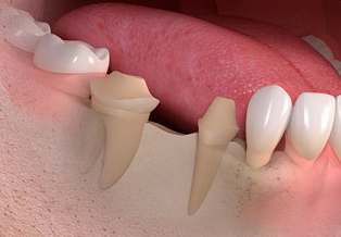 Two healthy neighbouring teeth are ground down to support a bridge - loss of tooth substance.