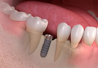 Tooth replacement with a dental implant.